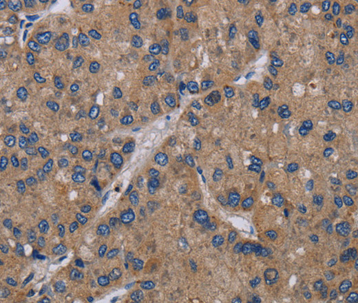 Immunohistochemistry of paraffin-embedded Human liver cancer using NECTIN4 Polyclonal Antibody at dilution of 1:40