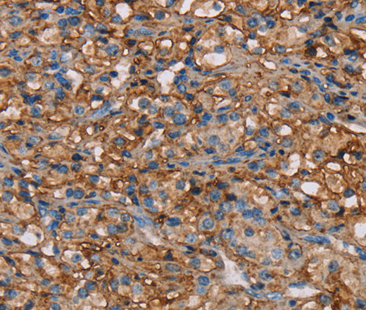 Immunohistochemistry of paraffin-embedded Human prostate cancer tissue using NEDD4L Polyclonal Antibody at dilution 1:50