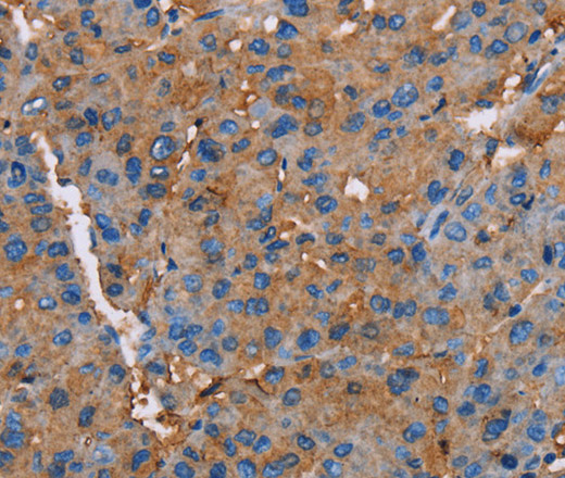 Immunohistochemistry of paraffin-embedded Human liver cancer tissue using NLGN1 Polyclonal Antibody at dilution 1:50