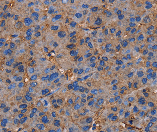 Immunohistochemistry of paraffin-embedded Human liver cancer tissue using NRIP3 Polyclonal Antibody at dilution 1:60