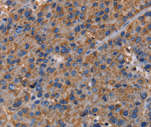 Immunohistochemistry of paraffin-embedded Human liver cancer using NUP62 Polyclonal Antibody at dilution of 1:40