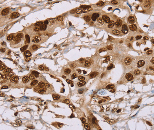 Immunohistochemistry of paraffin-embedded Human colon cancer using NUP50 Polyclonal Antibody at dilution of 1:30