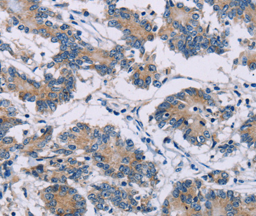 Immunohistochemistry of paraffin-embedded Human colon cancer using ODF2 Polyclonal Antibody at dilution of 1:30