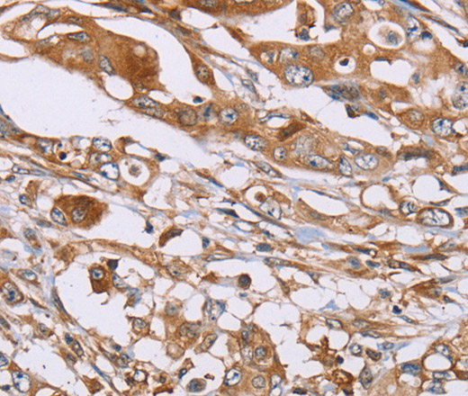 Immunohistochemistry of paraffin-embedded Human colon cancer using OS9 Polyclonal Antibody at dilution of 1:30