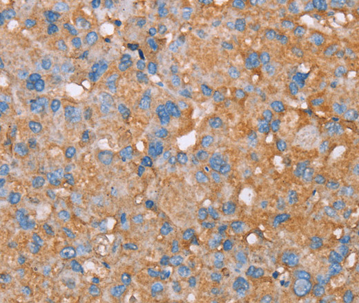 Immunohistochemistry of paraffin-embedded Human liver cancer tissue using PAGE5 Polyclonal Antibody at dilution 1:55