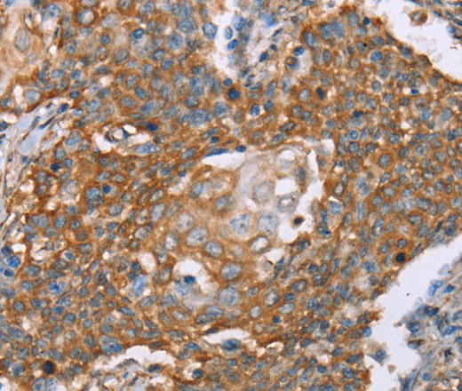 Immunohistochemistry of paraffin-embedded Human cervical cancer using PAICS Polyclonal Antibody at dilution of 1:50