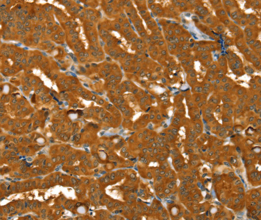 Immunohistochemistry of paraffin-embedded Human thyroid cancer using PYGM Polyclonal Antibody at dilution of 1:30