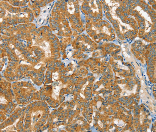 Immunohistochemistry of paraffin-embedded Human thyroid cancer tissue using RAB25 Polyclonal Antibody at dilution 1:40