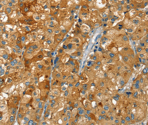 Immunohistochemistry of paraffin-embedded Human liver cancer tissue using RAB25 Polyclonal Antibody at dilution 1:40