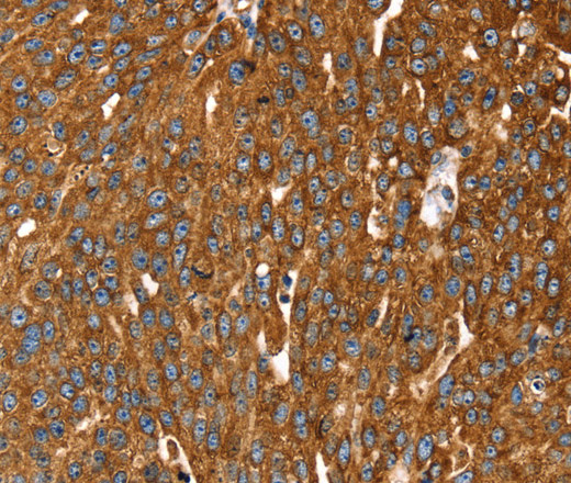 Immunohistochemistry of paraffin-embedded Human breast cancer tissue using RASSF3 Polyclonal Antibody at dilution 1:35