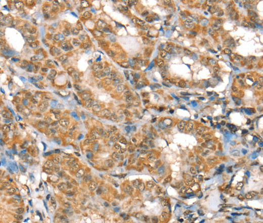 Immunohistochemistry of paraffin-embedded Human thyroid cancer using RBM5 Polyclonal Antibody at dilution of 1:30