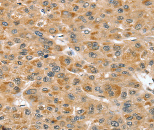 Immunohistochemistry of paraffin-embedded Human liver cancer using RNH1 Polyclonal Antibody at dilution of 1:30