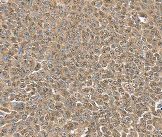 Immunohistochemistry of paraffin-embedded Human ovarian cancer using RNH1 Polyclonal Antibody at dilution of 1:30