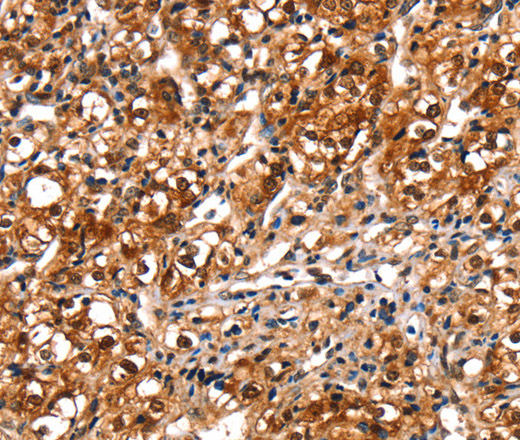 Immunohistochemistry of paraffin-embedded Human prostate cancer tissue using TRIM69 Polyclonal Antibody at dilution 1:40