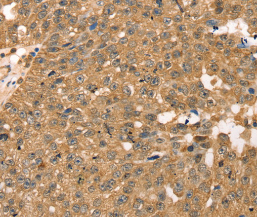 Immunohistochemistry of paraffin-embedded Human breast cancer tissue using RPLP2 Polyclonal Antibody at dilution 1:40