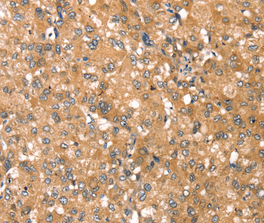 Immunohistochemistry of paraffin-embedded Human liver cancer using RPS6KA1 Polyclonal Antibody at dilution of 1:45