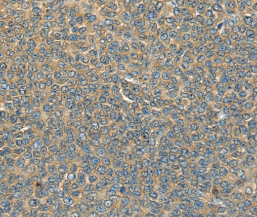 Immunohistochemistry of paraffin-embedded Human ovarian cancer tissue using DHCR24 Polyclonal Antibody at dilution 1:40