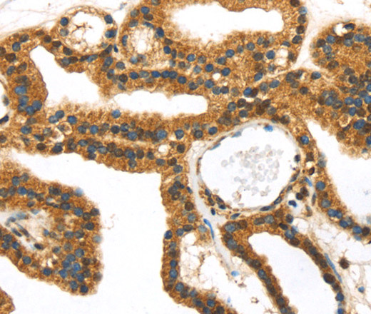 Immunohistochemistry of paraffin-embedded Human thyroid cancer tissue using SERPINB8 Polyclonal Antibody at dilution 1:40