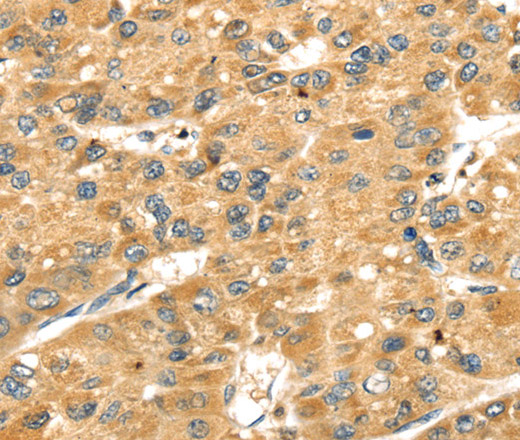 Immunohistochemistry of paraffin-embedded Human liver cancer tissue using SH3KBP1 Polyclonal Antibody at dilution 1:40