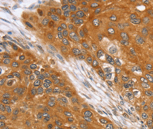 Immunohistochemistry of paraffin-embedded Human esophagus cancer using SLC25A13 Polyclonal Antibody at dilution of 1:35