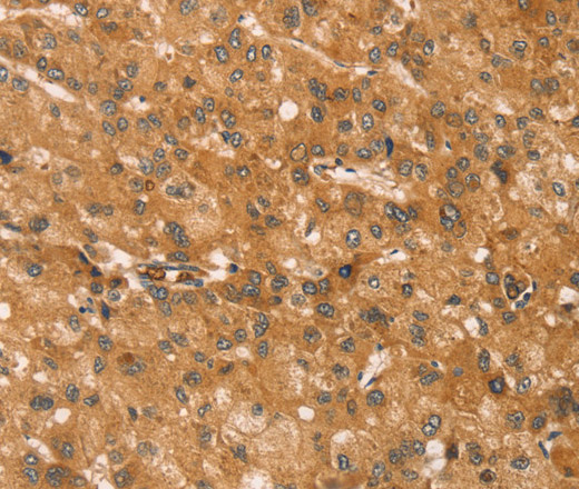 Immunohistochemistry of paraffin-embedded Human liver cancer tissue using SNAP29 Polyclonal Antibody at dilution 1:45