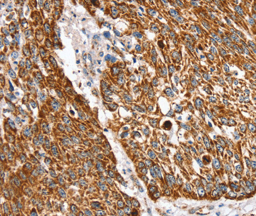 Immunohistochemistry of paraffin-embedded Human lung cancer using SSBP1 Polyclonal Antibody at dilution of 1:30