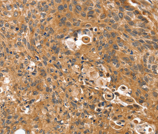 Immunohistochemistry of paraffin-embedded Human esophagus cancer tissue using SSX2IP Polyclonal Antibody at dilution 1:35