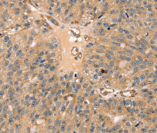 Immunohistochemistry of paraffin-embedded Human breast cancer tissue using SSX2IP Polyclonal Antibody at dilution 1:35