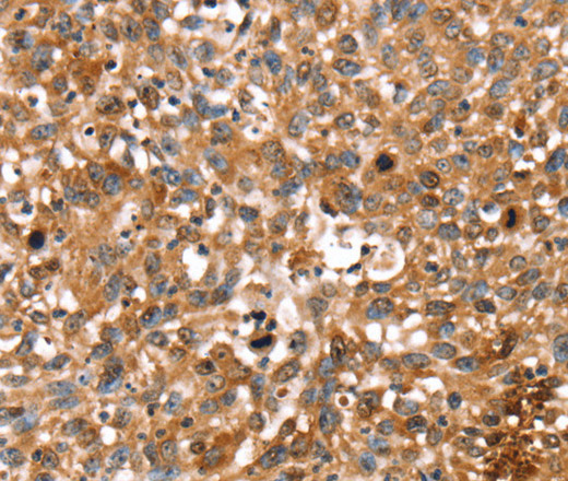 Immunohistochemistry of paraffin-embedded Human lung cancer using STAR Polyclonal Antibody at dilution of 1:35