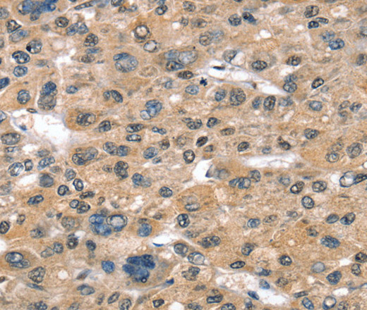 Immunohistochemistry of paraffin-embedded Human liver cancer using SULT1B1 Polyclonal Antibody at dilution of 1:30