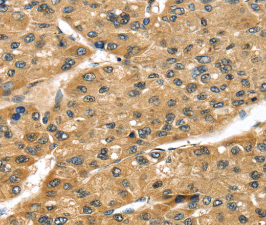 Immunohistochemistry of paraffin-embedded Human liver cancer tissue using STX8 Polyclonal Antibody at dilution 1:45