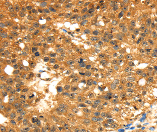 Immunohistochemistry of paraffin-embedded Human breast cancer tissue using STX8 Polyclonal Antibody at dilution 1:45