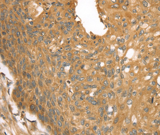 Immunohistochemistry of paraffin-embedded Human esophagus cancer using STX16 Polyclonal Antibody at dilution of 1:30