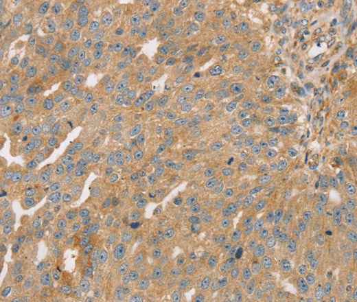 Immunohistochemistry of paraffin-embedded Human breast cancer using STX16 Polyclonal Antibody at dilution of 1:30