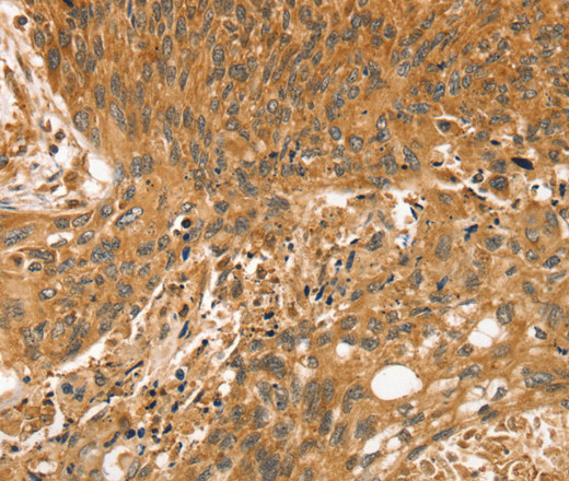 Immunohistochemistry of paraffin-embedded Human esophagus cancer using STX10 Polyclonal Antibody at dilution of 1:35