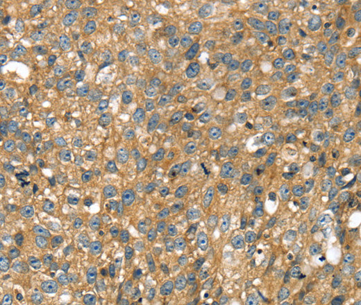 Immunohistochemistry of paraffin-embedded Human breast cancer using STX11 Polyclonal Antibody at dilution of 1:30