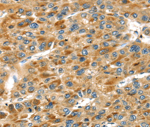 Immunohistochemistry of paraffin-embedded Human liver cancer using STX11 Polyclonal Antibody at dilution of 1:30