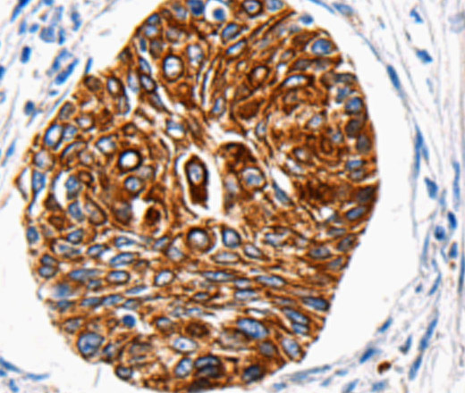 Immunohistochemistry of paraffin-embedded Human cervical cancer  using HTR1A Polyclonal Antibody at dilution of 1:100