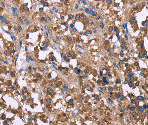 Immunohistochemistry of paraffin-embedded Human thyroid cancer using SERPINA1 Polyclonal Antibody at dilution of 1:30