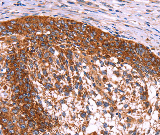 Immunohistochemistry of paraffin-embedded Human cervical cancer using ABI1 Polyclonal Antibody at dilution of 1:40