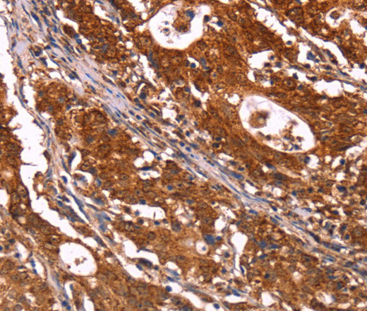 Immunohistochemistry of paraffin-embedded Human gastric cancer using ABI1 Polyclonal Antibody at dilution of 1:40