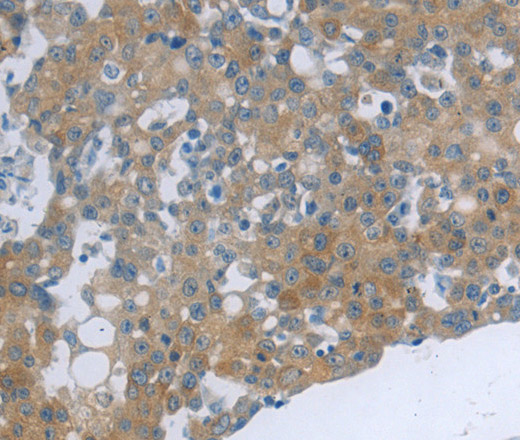 Immunohistochemistry of paraffin-embedded Human ovarian cancer tissue using TNK2 Polyclonal Antibody at dilution 1:70