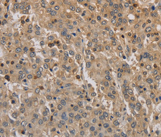 Immunohistochemistry of paraffin-embedded Human liver cancer using ADO Polyclonal Antibody at dilution of 1:30