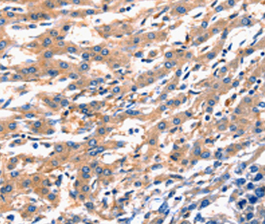 Immunohistochemistry of paraffin-embedded Human liver cancer using RAB18 Polyclonal Antibody at dilution of 1:300