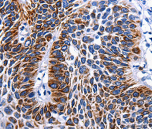 Immunohistochemistry of paraffin-embedded Human liver cancer tissue using RAB25 Polyclonal Antibody at dilution 1:50