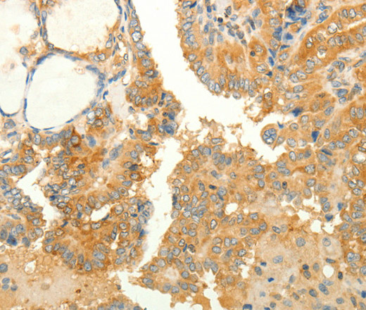 Immunohistochemistry of paraffin-embedded Human thyroid cancer tissue using RAB35 Polyclonal Antibody at dilution 1:40