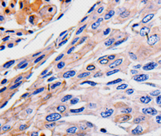 Immunohistochemistry of paraffin-embedded Human liver cancer tissue using RAB41 Polyclonal Antibody at dilution 1:60