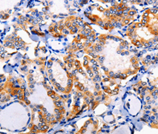 Immunohistochemistry of paraffin-embedded Human thyroid cancer tissue using AP1B1 Polyclonal Antibody at dilution 1:100