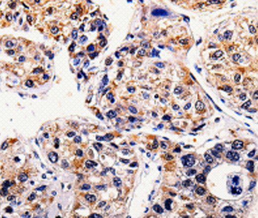 Immunohistochemistry of paraffin-embedded Human liver cancer tissue using AP1B1 Polyclonal Antibody at dilution 1:100