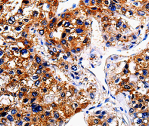 Immunohistochemistry of paraffin-embedded Human liver cancer tissue using BIRC6 Polyclonal Antibody at dilution 1:50